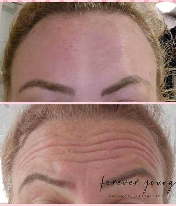 Anti-Wrinkle Treatment image