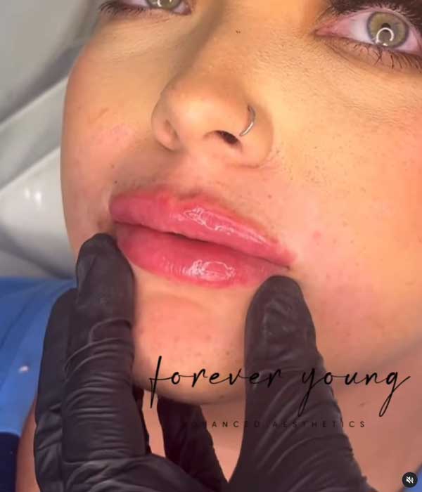 Dermal Fillers image